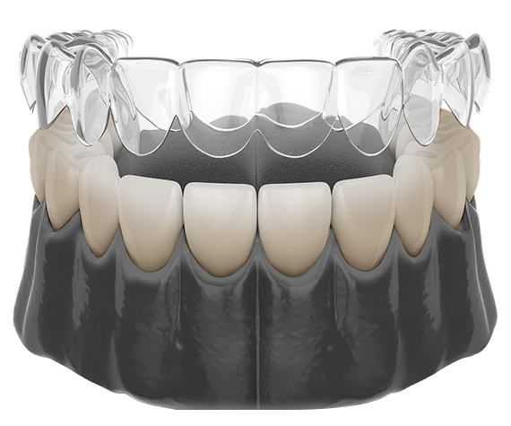 Ortodontiline ravi kapedega.